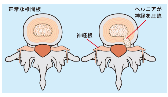 椎間板ヘルニアの原因